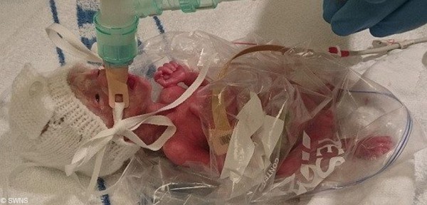 A La Naissance Elle Pesait Que 500 Gr Voyez Ce Que Les Medecins Ont Fait Pour La Sauver